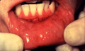 Rakovina dutiny ústní