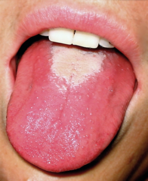 Hnědý povlak jazyka